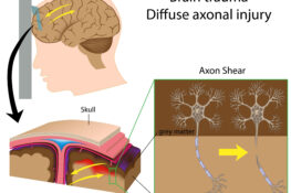 Review of TES/CTE: Diagnosis, Criteria, and Challenges | myneuronews.com