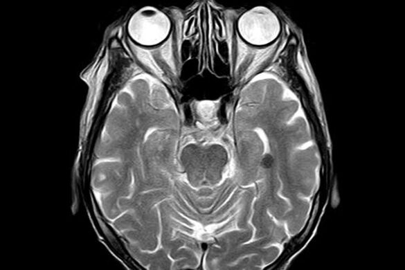 Distinguishing Mild Neurocognitive Disorder Due to TBI in DSM-5 from ...