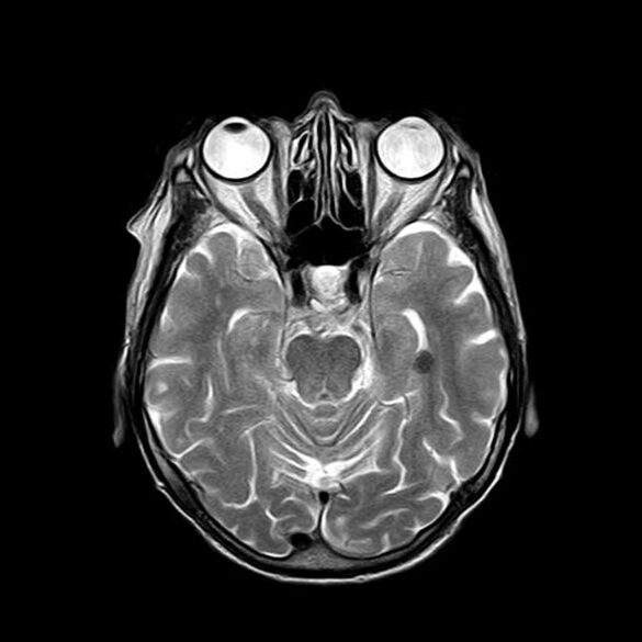 Review of TES/CTE: Diagnosis, Criteria, and Challenges | myneuronews.com