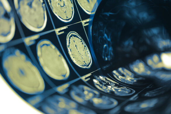 Distinguishing Mild Neurocognitive Disorder Due to TBI in DSM-5 from ...