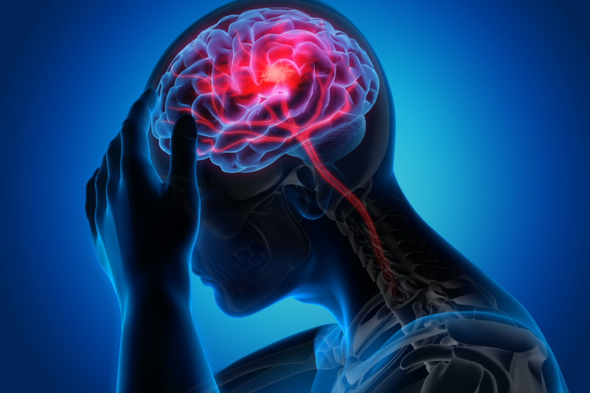 Man,With,A,Headache,-,Stroke,-3d,Illustration